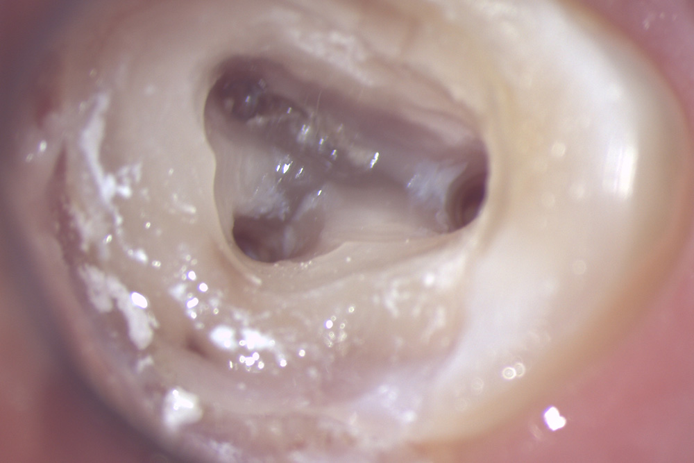 歯根の管